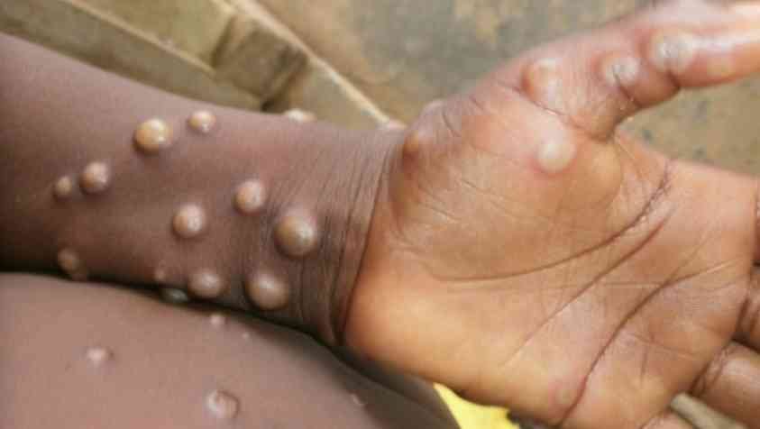 Monkeypox in Tamil: குரங்கு அம்மை நோய் இப்படி தான் பரவுதா? அறிகுறிகள், சிகிச்சை முறைகள் என்னென்ன?