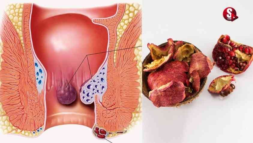 How to Cure Piles at Home in Tamil: மூல நோயால் ஏற்படும் வலி, இரத்தப் போக்கை குறைக்க...