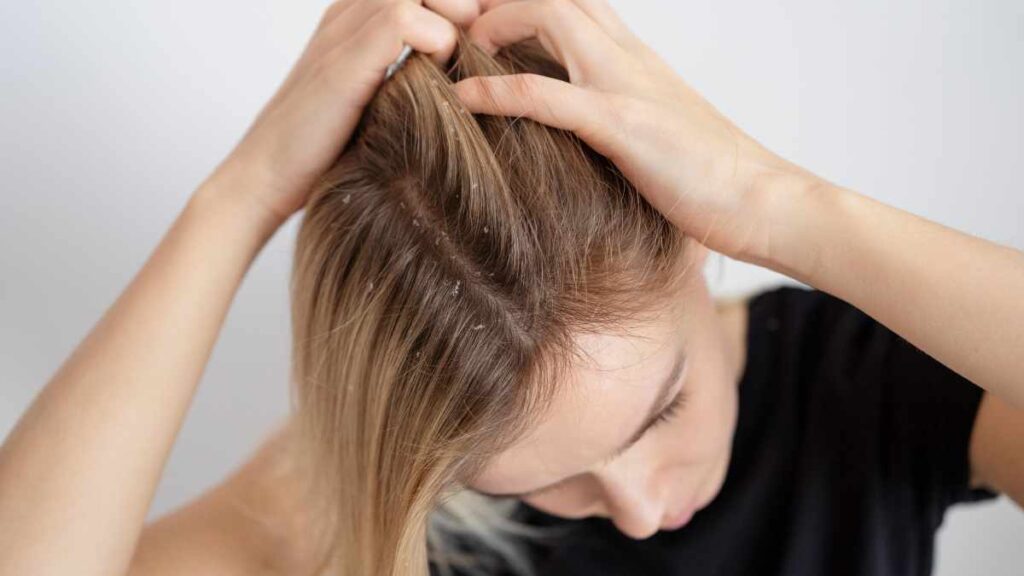 Natural Remedies for Dandruff